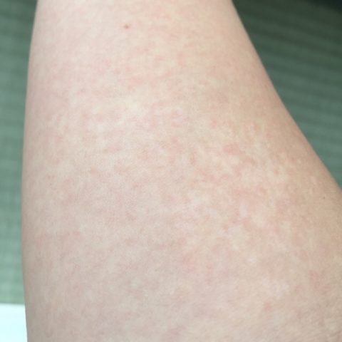 熱なし かゆみなし 赤い発疹 「子どもの皮膚にぶつぶつした発疹ができた」とき―熱、かゆみ、赤みは危険な症状？
